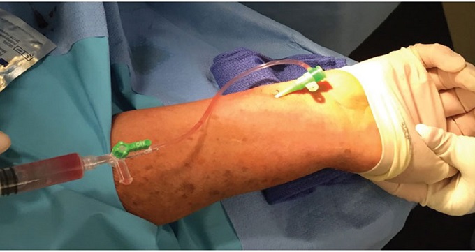 اقدامات قبل از آنژیوگرافی قلب