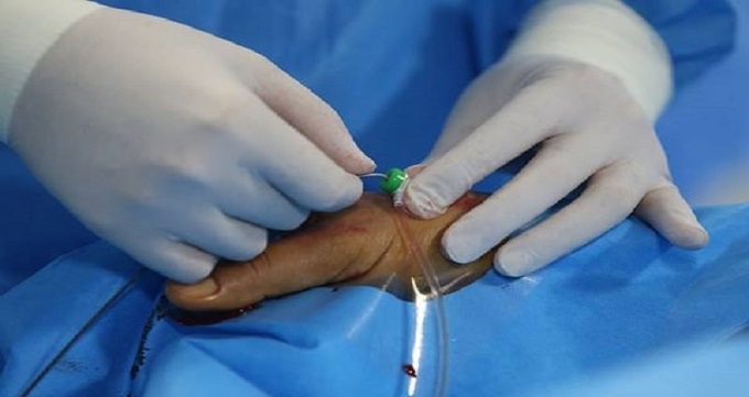 تفاوت بستری در آنژیوگرافی