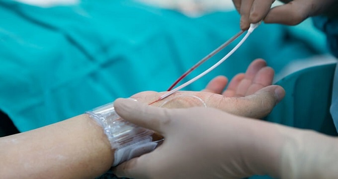 تفاوت آنژیوگرافی و آنژیوپلاستی